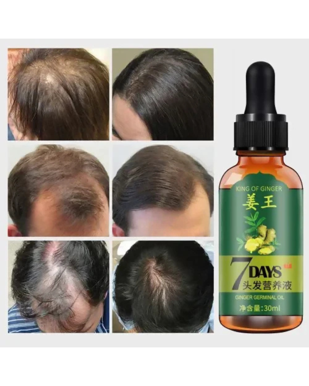 Aichun Beauty Ginger Hair Growth Oil – 7 Days Rapid Growth Essence for Bald Spots, Edges & Thinning Hair (30ml)